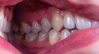 Sorriso Desalinhado: 6 Problemas Ocultos Além da Estética e Saúde Bucal