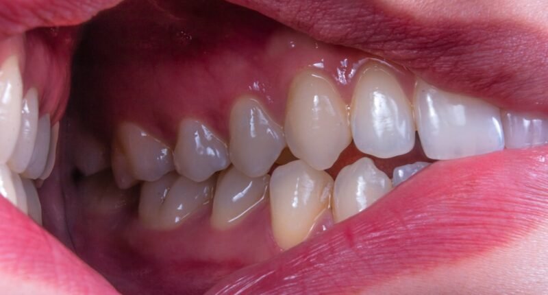 Sorriso Desalinhado: 6 Problemas Ocultos Além da Estética e Saúde Bucal